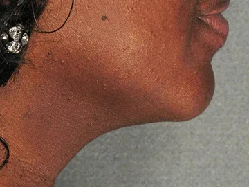 Ultherapy After