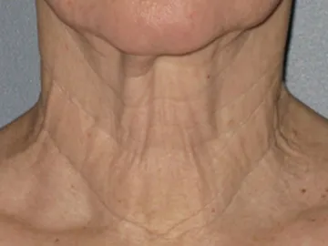 Ultherapy Before
