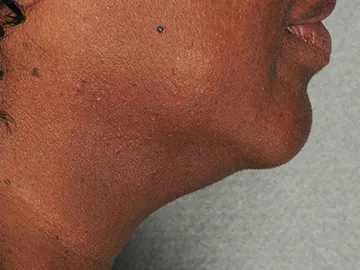 Ultherapy Before