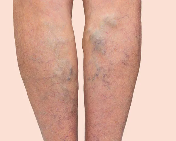 Varicose veins