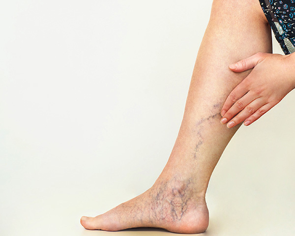 Vein Treatment