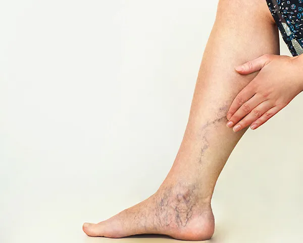 Vein Treatment Jersey City